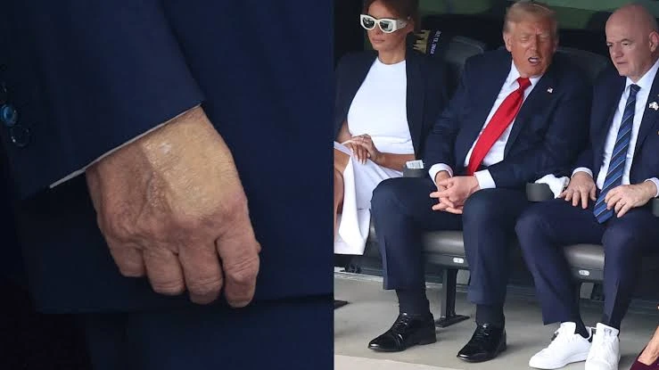 Kakinya Bengkak, Trump Didiagnosis Menderita Insufisiensi Vena Kronis