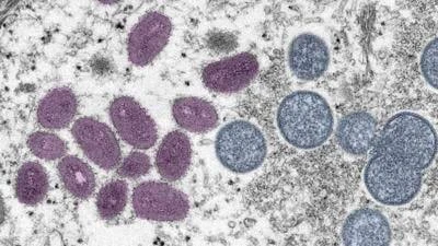 Bisa Menyebar ke Seluruh Dunia, Wabah Mpox Clade 1b Bisa Jadi Pandemi Baru